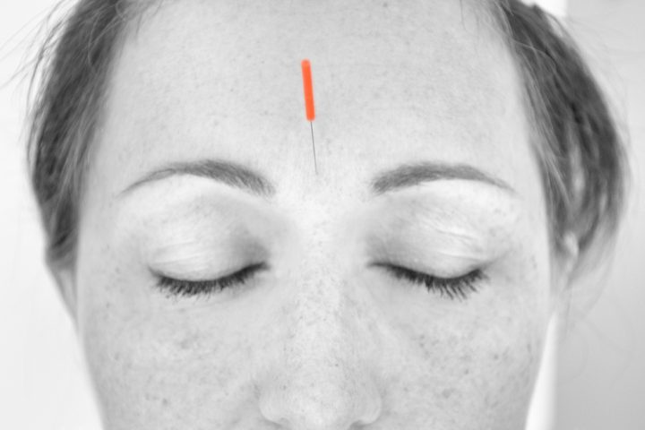 Close,Up,Of,Red,Headed,Woman,With,Acupuncture,Tool,Attached